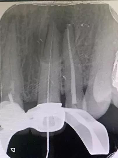 已经有牙洞了怎么根管治疗,牙髓腐烂坏死再做根管治疗会痛吗