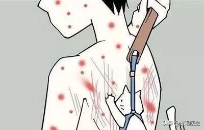 人工划痕症是顽固皮肤病吗,人工划痕症稀有吗