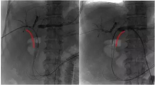 胆管恶性肿瘤保守治疗,胆道射频消融的危害