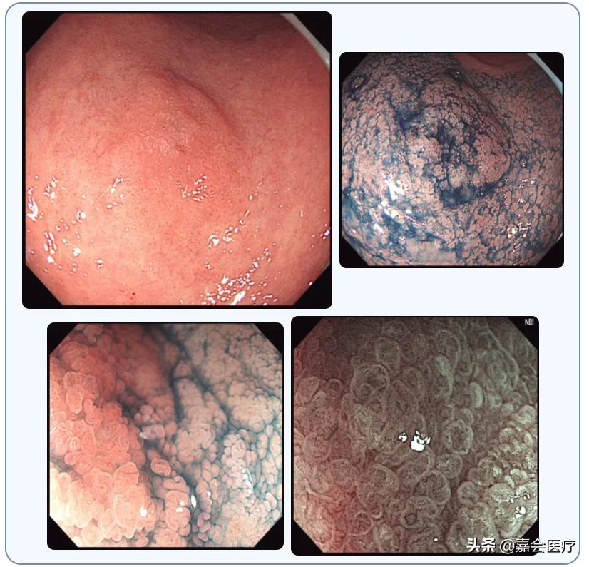胃镜中的早癌筛查,胃镜能查出消化道肿瘤吗