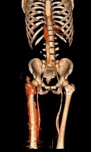 【科普创新月】“老烂腿”，我们应该怎么办？