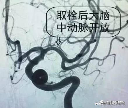 如何让身体不形成血栓,一个动作让血栓变好