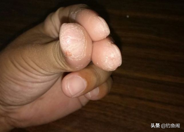 钓鱼香虎手能彻底根除吗,香虎手治好后还能钓鱼吗