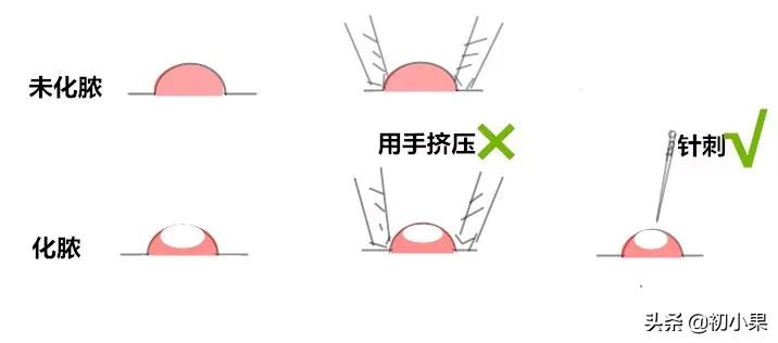 高中男生祛痘护肤推荐,男生祛痘药膏推荐