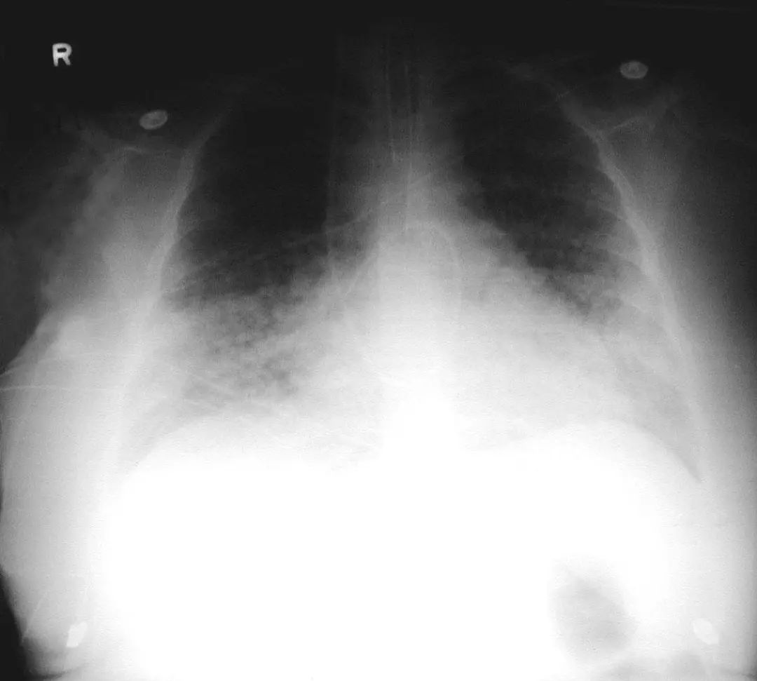 肺炎炎症图片,肺炎病历单图片