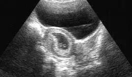 报告上写的是彩超但是是黑白图片,做彩超为什么出来的是黑白图像