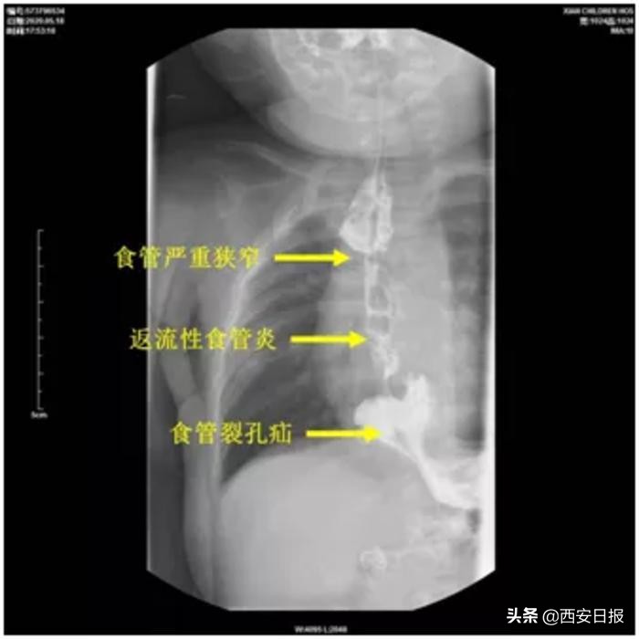 食道堵塞10毫米,食道狭窄1.5毫米可以扩张吗