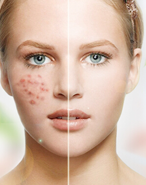 新手长痘护肤正确思路,护肤讲座知识