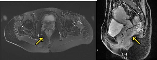 直肠癌放化疗后两年未复发,直肠癌术后放化疗有复发的吗