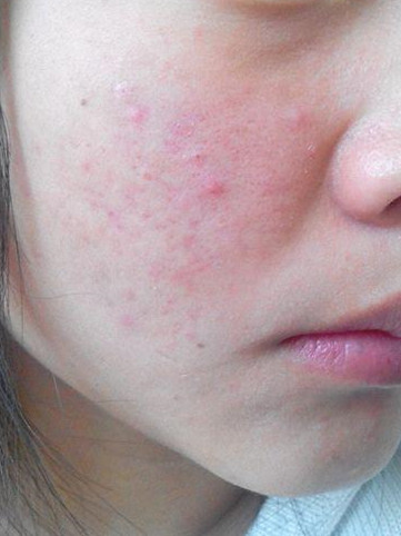 天天在家熬夜身上长痘,在家熬夜玩手机