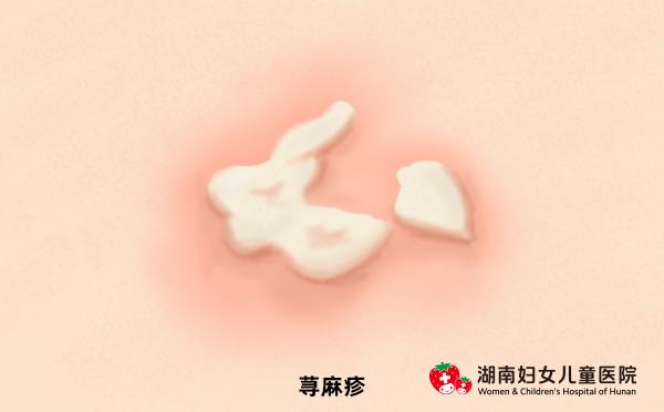 小孩夏天怎么防止痒疹,夏天的宝宝怎么避免热疹