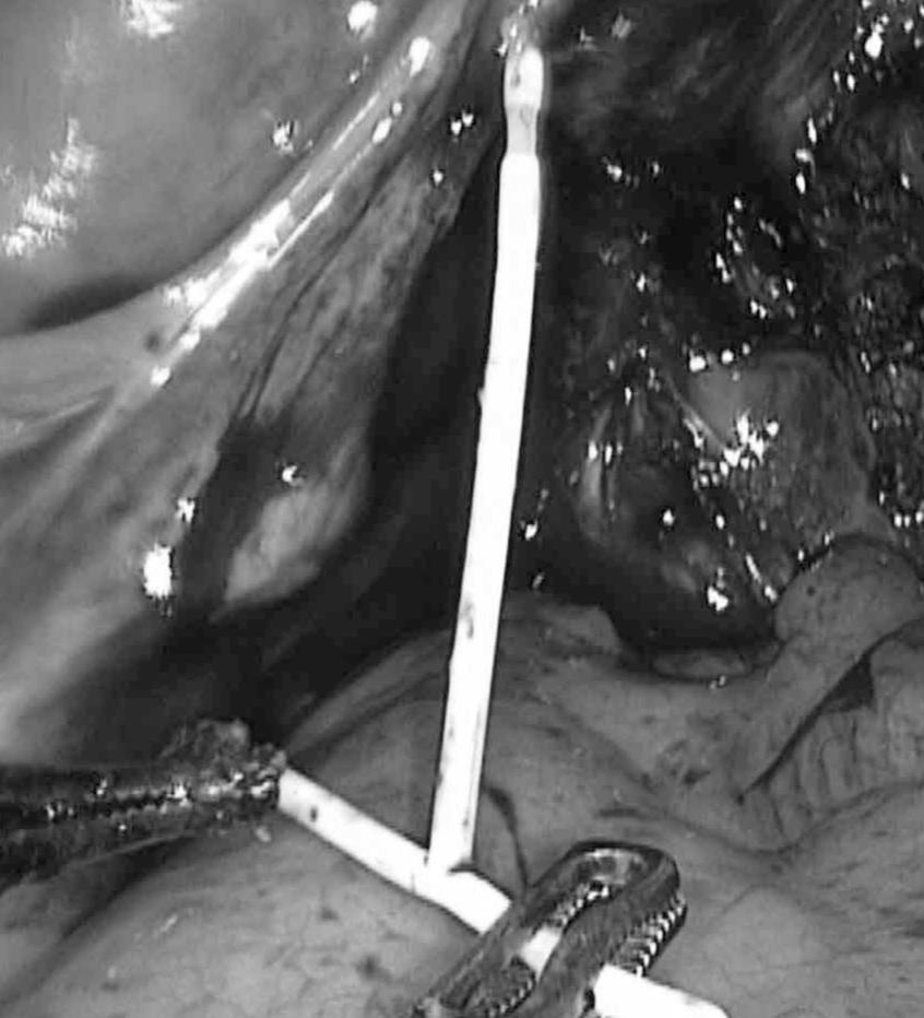 放了节育环三十年了现在取行吗,放了30多年的节育环还能怀孕吗