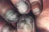 足疗店灰指甲治疗费用大概多少钱,得了灰指甲一个传染俩靠谱吗