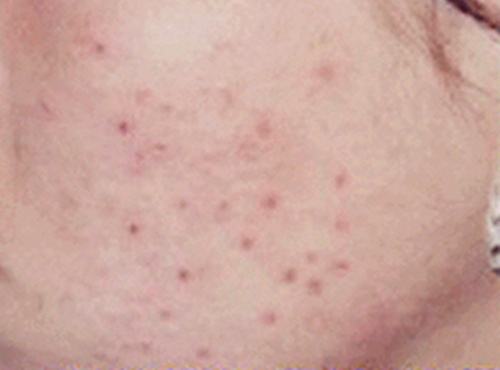 脸上有坑坑洼洼的痘印怎么消除,脸上坑坑洼洼女生