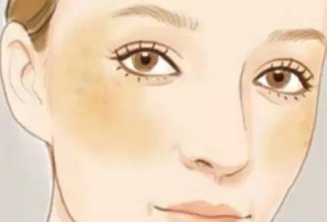 医生建议怎么祛斑,医生教你如何祛斑