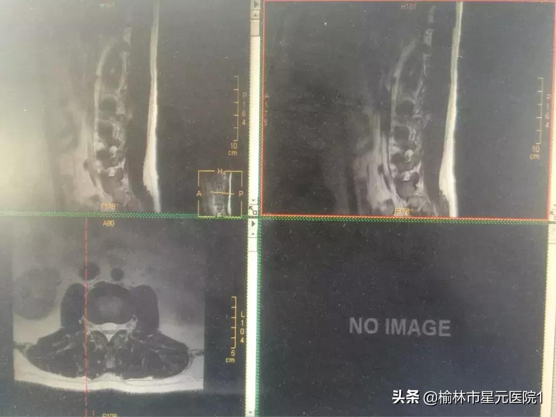 榆林佳县治疗腰椎间盘突出,榆林腰椎间盘突出最有效治疗