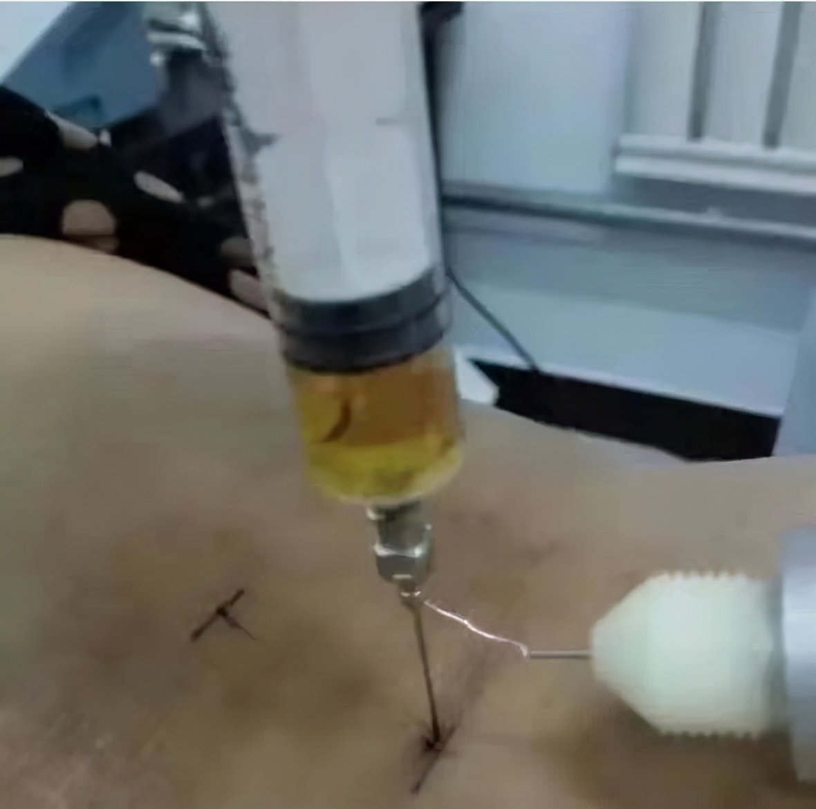 解决肿瘤患者顽固性呃逆优秀案例分享