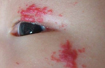 宝宝胎记的症状有哪些,宝宝出生有胎记是怎么来的