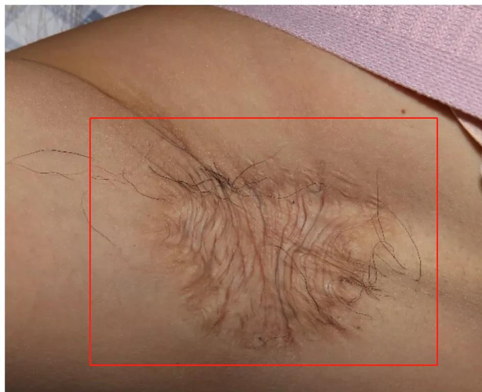 狐臭手术留下的疤痕怎么消除,狐臭手术留下的疤痕又痛又痒