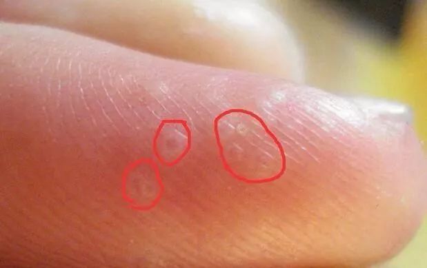 手上得汗疱疹疼该怎么办,手上汗疱疹奇痒用什么药