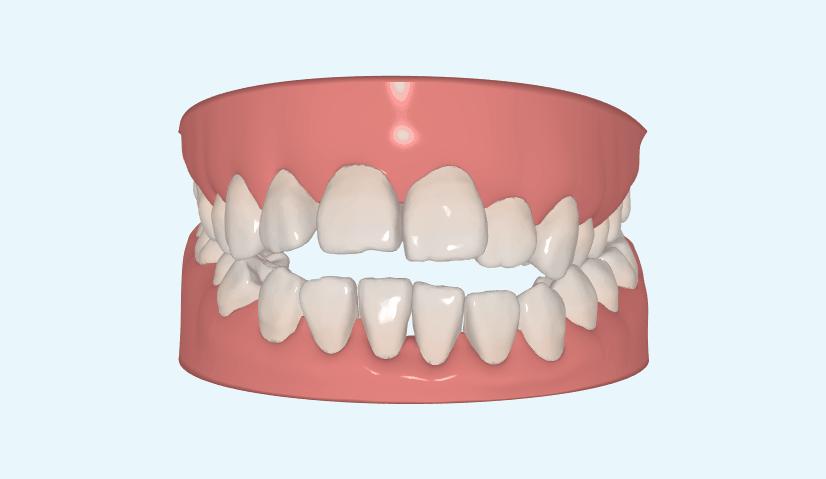 牙齿矫正对颜值有多大的影响,牙齿矫正对颜值的影响
