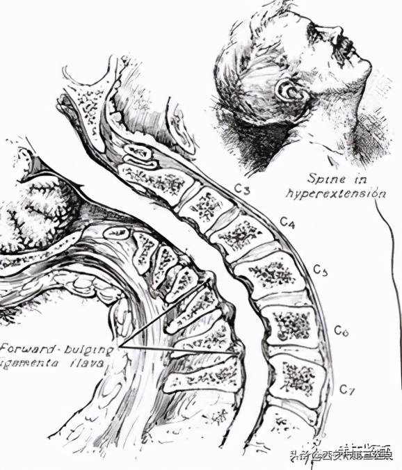 颈椎病减压手术安全么,手术脊髓减压