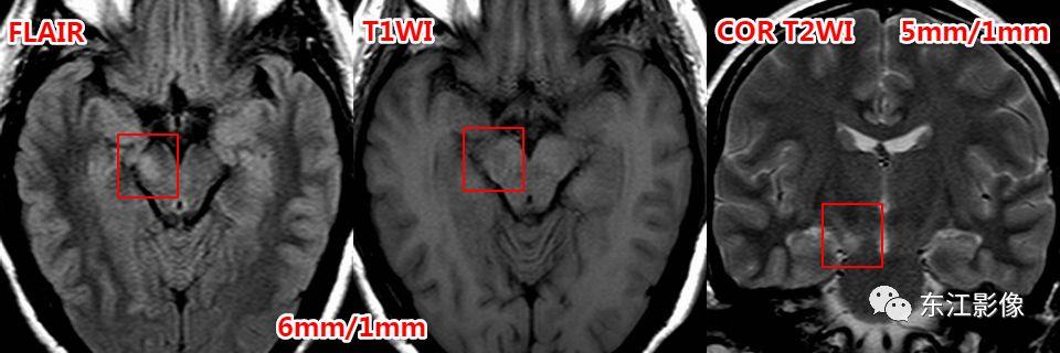 头颅mri扫描影像哪里找,头颅影像mra详细解说