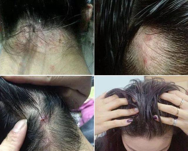 身上的螨虫会粘在衣服上吗,身上螨虫太多身体会烂么