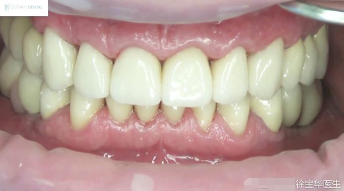 烤瓷牙贴片全口价格,贴片牙齿和烤瓷牙有哪些伤害