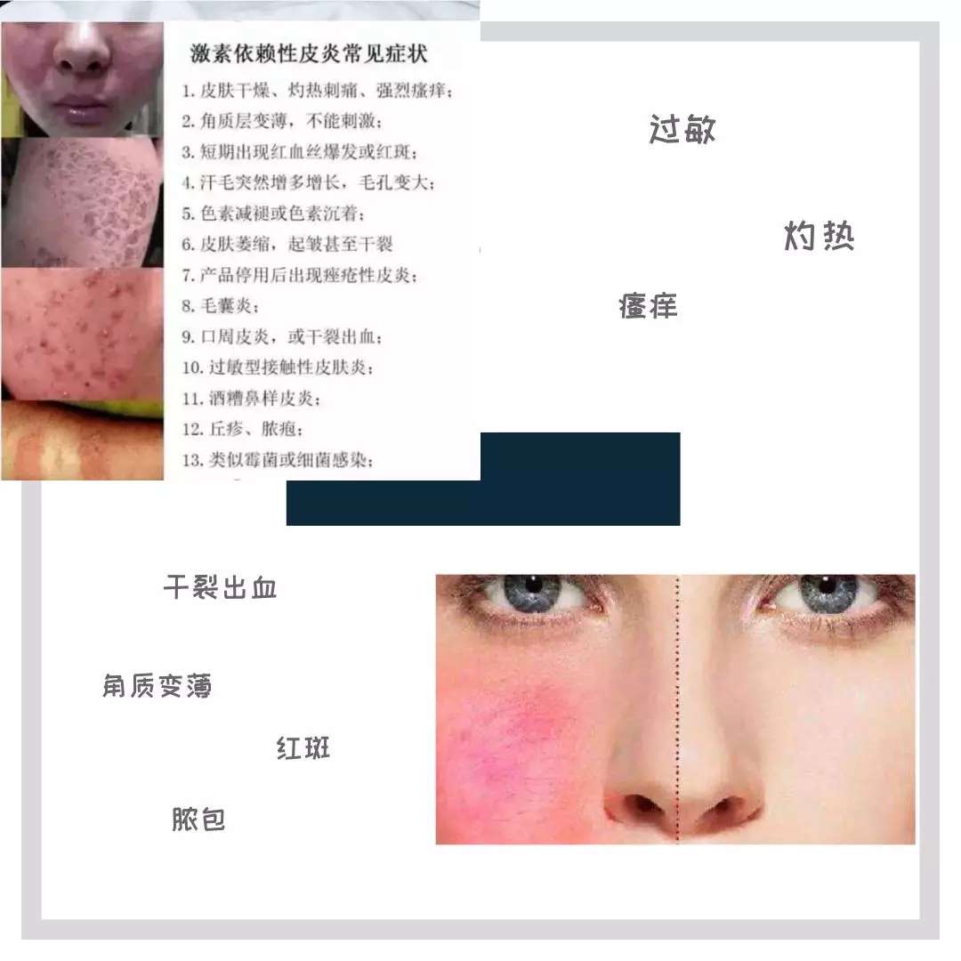 断激素后症状,什么叫断激素过敏反应