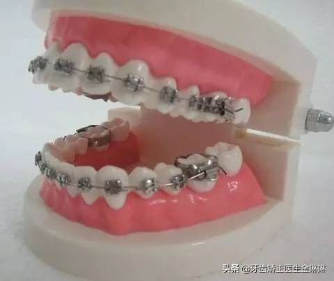 在山东做牙齿矫正去哪里好,16岁牙齿太稀牙小缝大怎么矫正