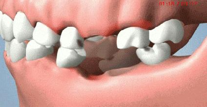 牙齿矫正最佳年龄中年,中年人龅牙可以牙齿矫正吗