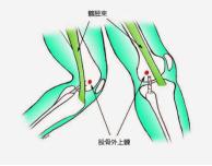 大腿外侧髂胫束综合征快速恢复,跑步如何避免髂胫束综合征