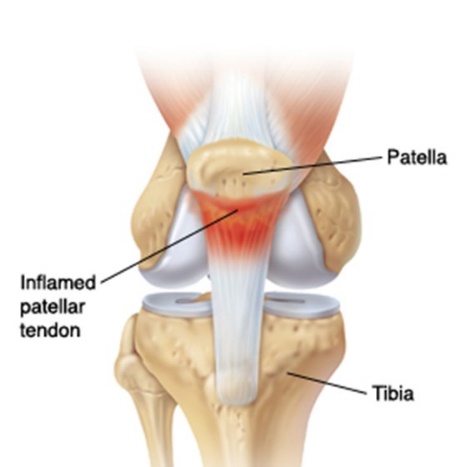 跑跳时膝盖内侧疼是什么原因,跑跳时膝盖疼