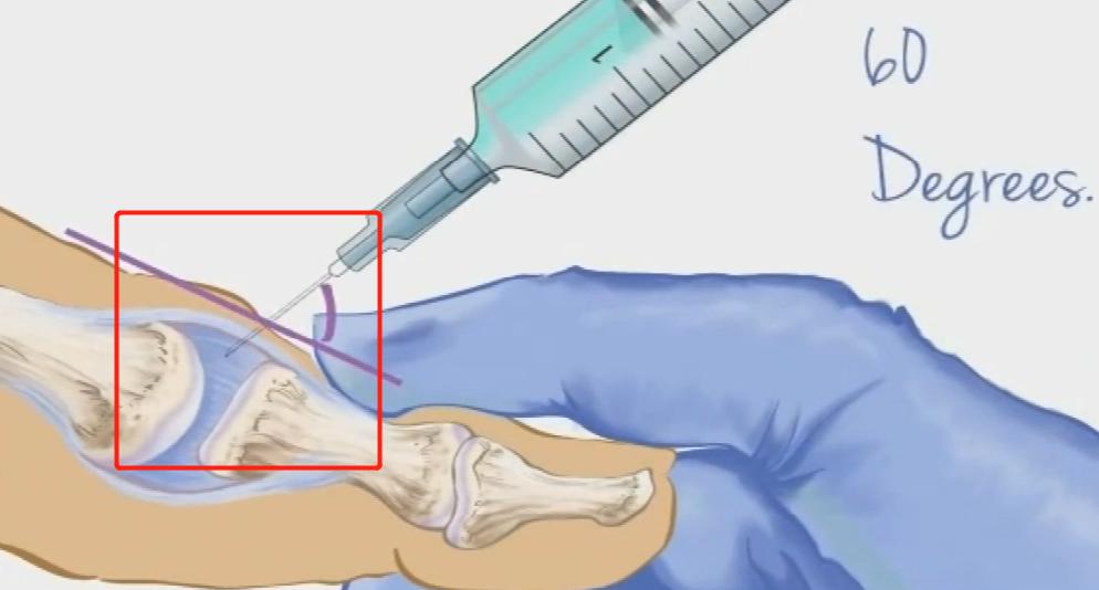 手指腱鞘炎怎么治好得快,手指有腱鞘炎怎么治才能好得快