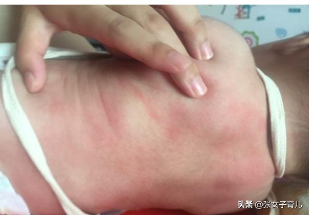 夏天宝宝长痱子有什么好办法吗,宝宝一到夏天就长痱子怎么办