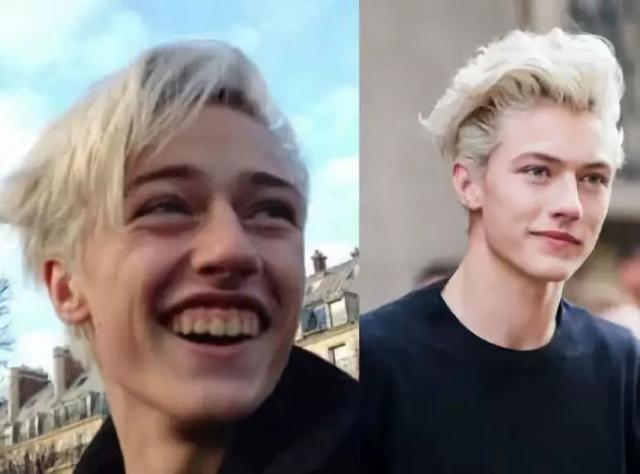 大笑时不自觉露出牙龈能否矫正,一笑牙龈就露出来了可以矫正吗