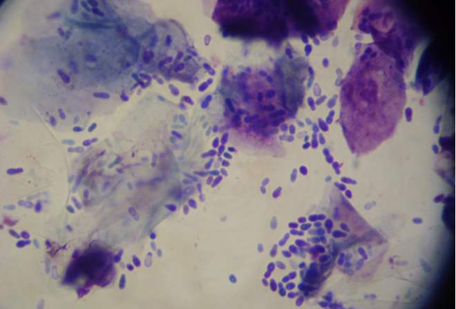 脂溢性皮炎和头皮糠疹的症状区别,脂溢性皮炎和头癣鉴别诊断