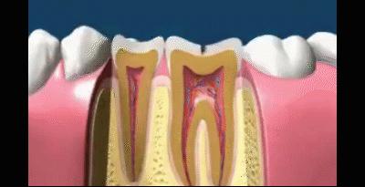 坏牙怎么办,补的牙坏了再补需要多少钱