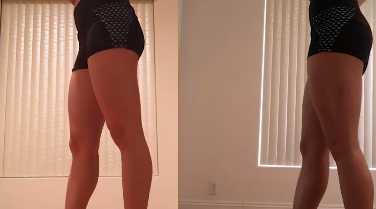 大腿粗的人运动磨腿根怎么办,细腿走路磨大腿内侧怎么办