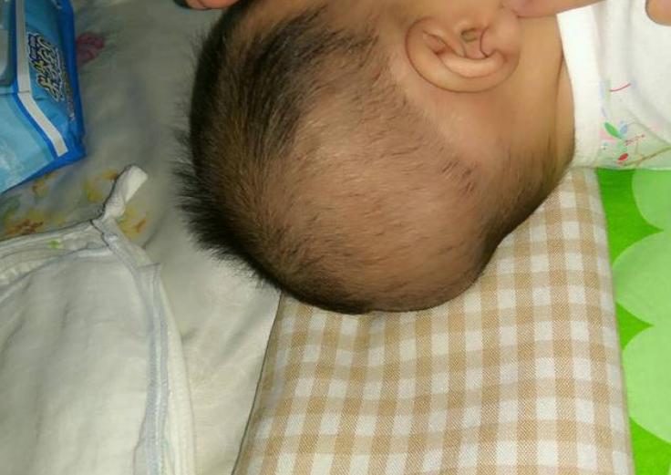 宝宝偏头睡的危害,宝宝偏头要睡哪侧纠正