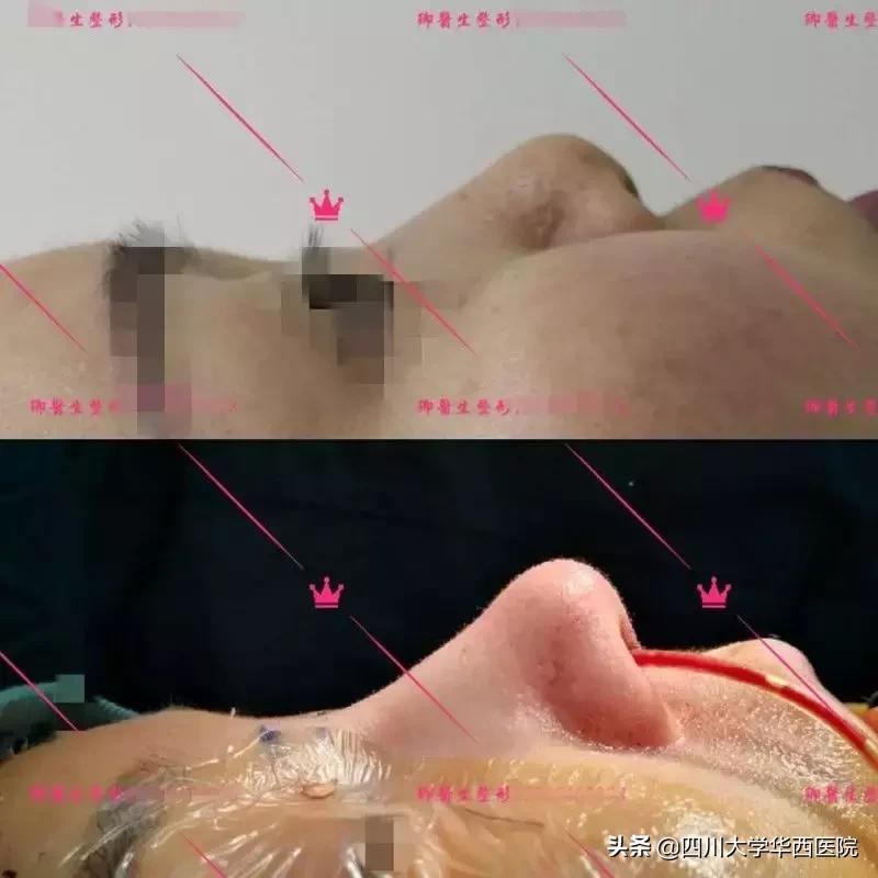 鼻子特别大怎么修,鼻子大如何修鼻子