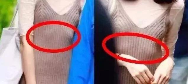 肋骨外翻生活体态怎么调整,体态矫正可以治疗肋骨外翻吗