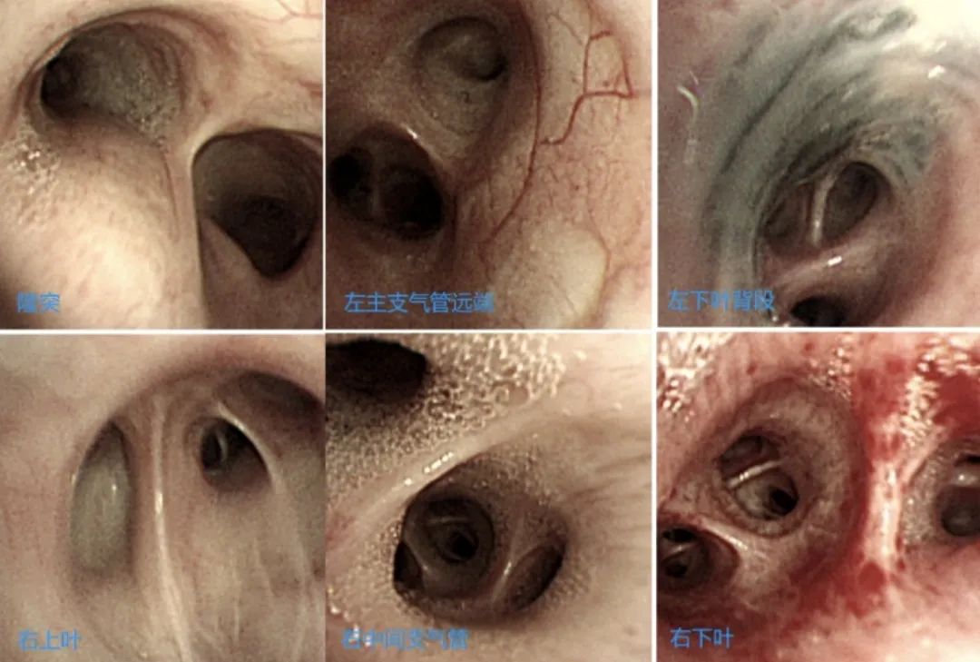 时隔一年再次住院,时隔一年旧病复发