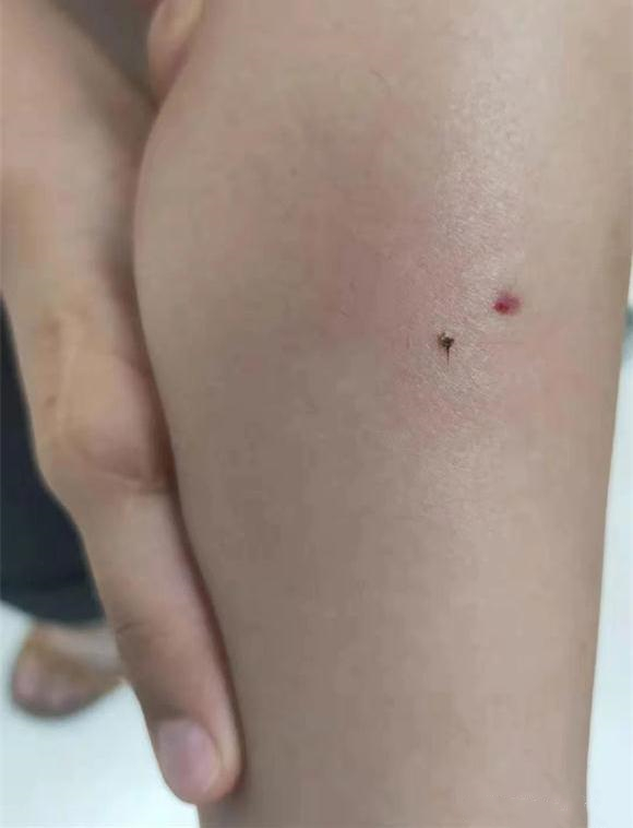 四岁孩子被蜜蜂咬了怎么处理,孩子被蜜蜂蜇妈妈在笑怎么办