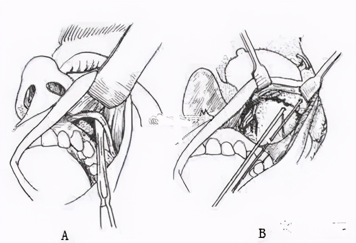 刻薄高颧骨面相,高颧骨到底是刻薄还是高级