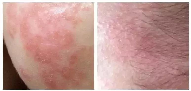 婴儿冬天长痱子怎么办教你除根,冬天宝宝会起热痱子吗