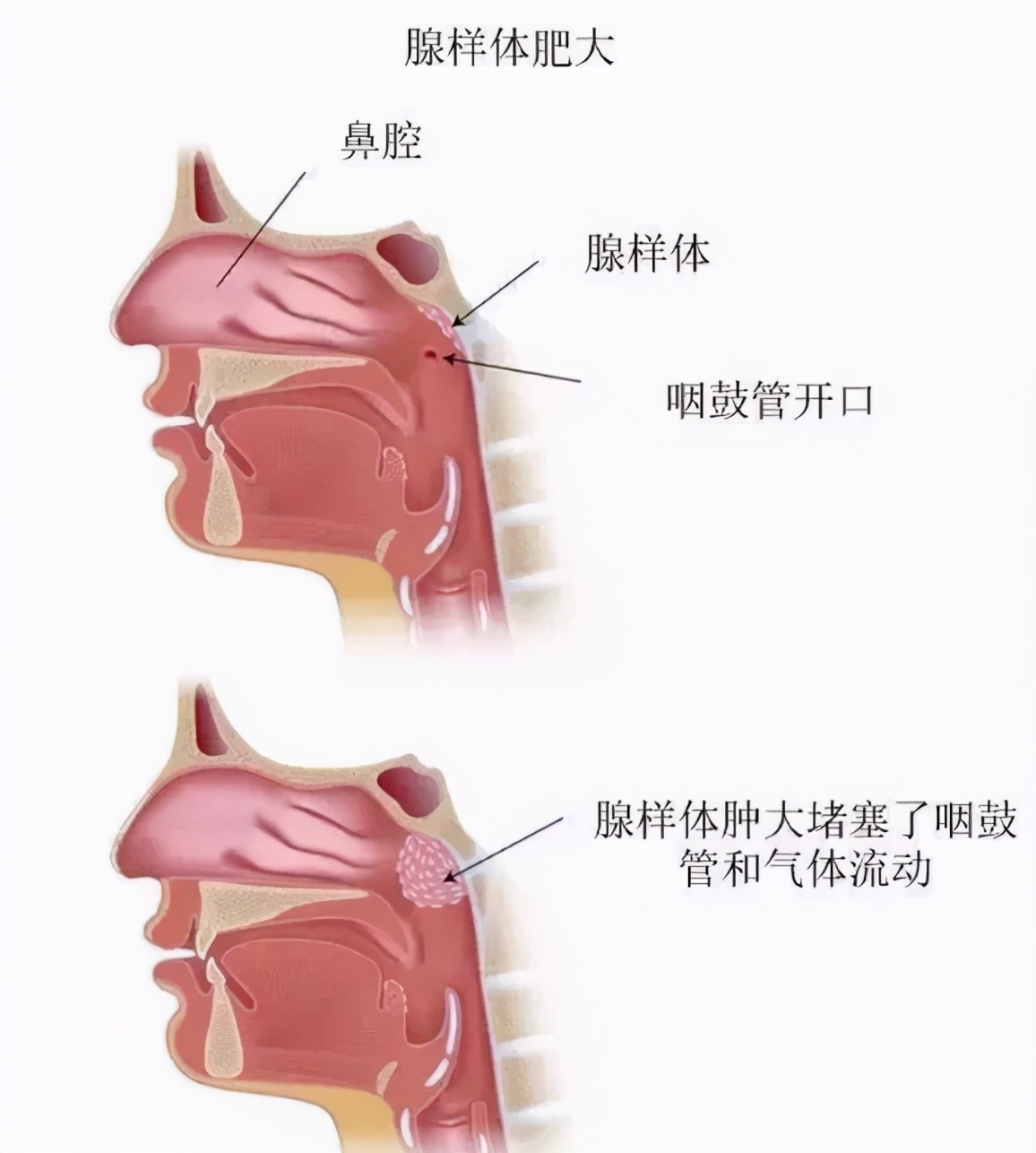 腺样体面容会让孩子变丑，一旦出现不能逆转！家长警惕6种表现