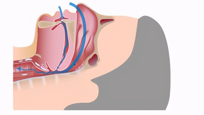 呼吸机止鼾选单水平还是双水平,止鼾呼吸机的正确使用方法