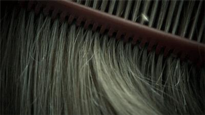 头皮屑严重如何处理好得快,头皮屑是怎么造成的如何治好